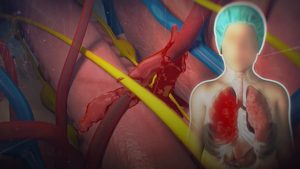 Forensic-Courtroom-Graphics